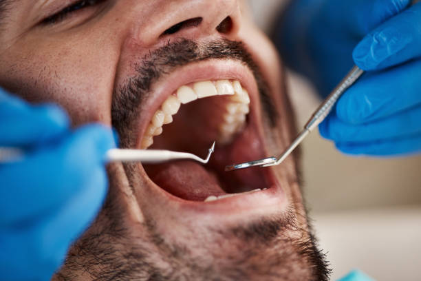 Best Chipped Tooth Repair Near Me  in Grand Saline, TX